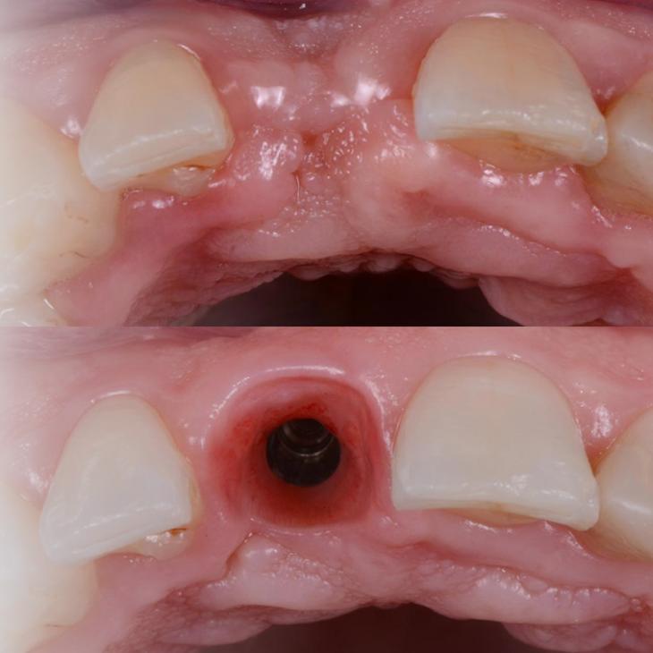 SEMINÁŘ IMPLANTOLOGIE 3.ČÁST