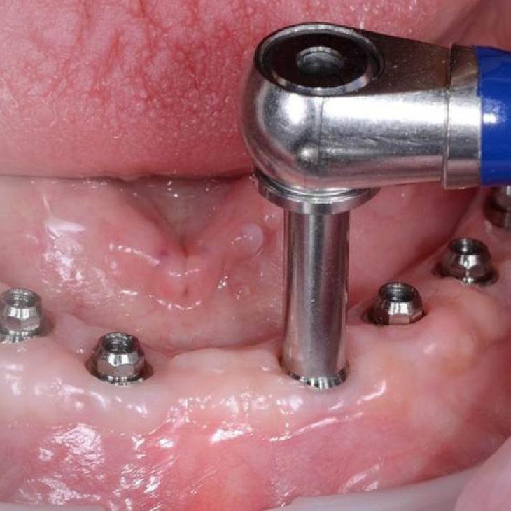 SEMINÁŘ IMPLANTOLOGIE 2.ČÁST