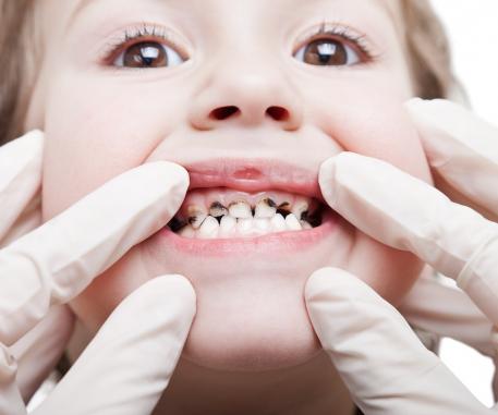 Ošetření zubního kazu u dětí