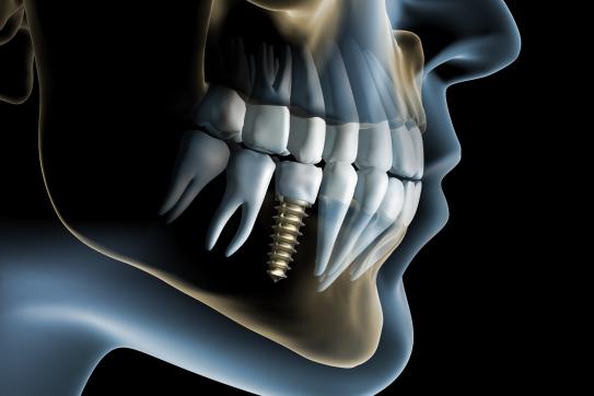 Jak dlouho nám vydrží zubní implantáty?