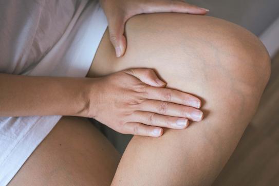 Těhotné ženy trápí křečové žíly na nohách i na rodidlech