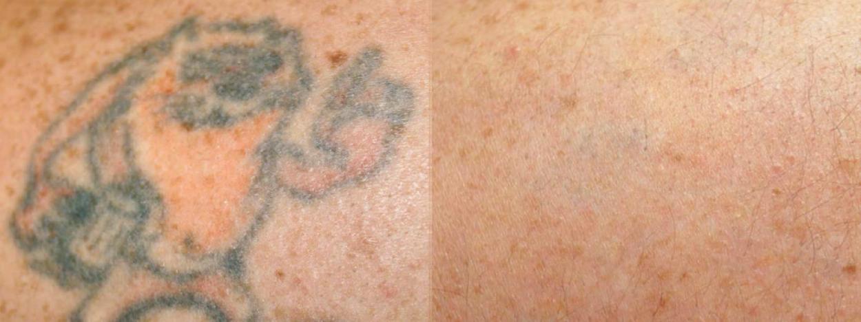 Tattoo removal | Asklepion