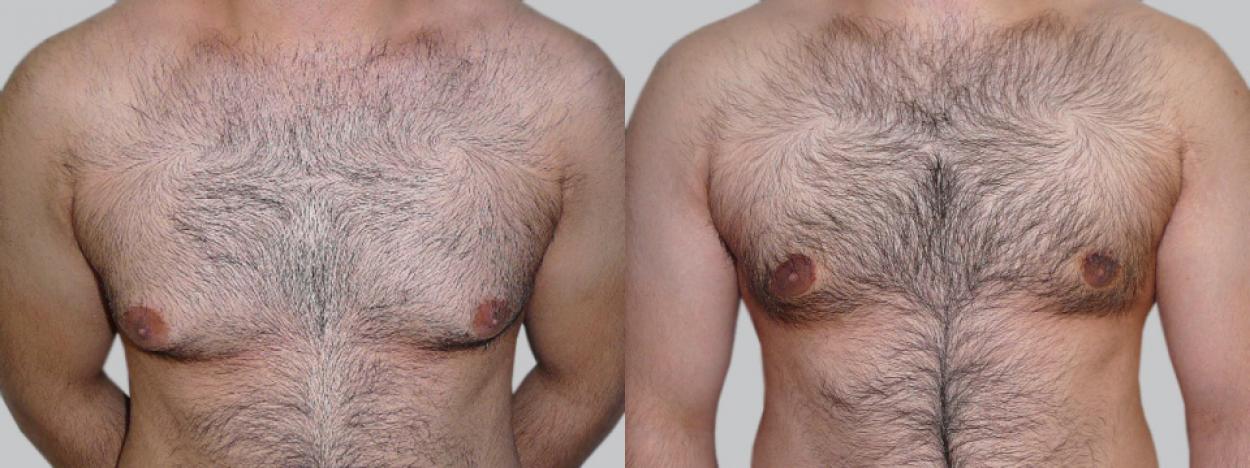 Пластическая операция груди у мужчин - гинекомастия | Asklepion